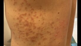 תפקידם של קטונים בניהול מצבי עור אוטואימוניים