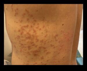 תפקידם של קטונים בניהול מצבי עור אוטואימוניים